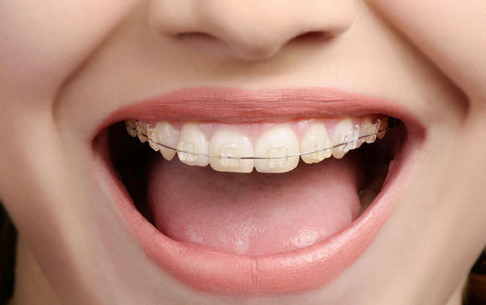 servicio-ortodoncia-belen-villacastin-clinica-dental